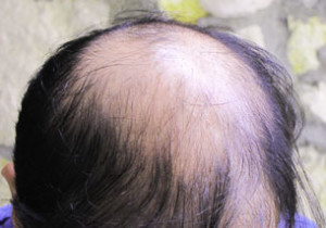 Exoderm Hair implant